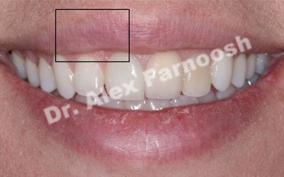 gummy-smile-after-1